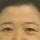 치료 전 이미지